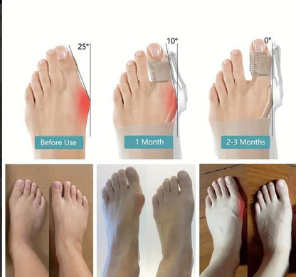 Hallux Valgus Schiene – Zehenkorrektur-Splint mit Drehknopf Einstellbar